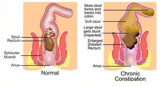 Old Age Loss Of Bowel 45