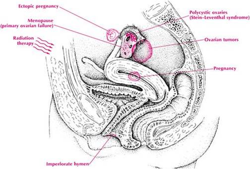 Menstrual Abnormalities