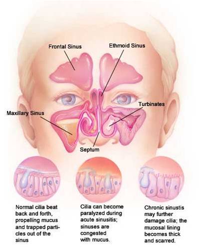 Polyps In Nose. Nasal Polyps:Homeopathic