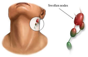 auroh homeopathy tonsillitis - swollen nodes